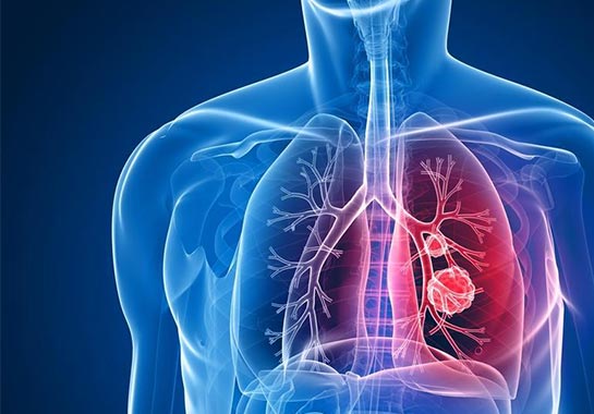 AM registra 1,3 mil novos casos de tuberculose de janeiro a maio de 2022